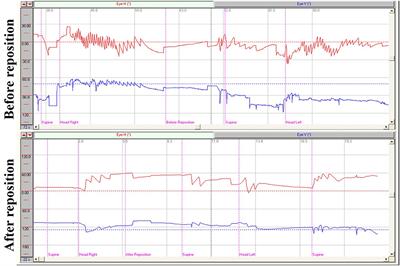 A Show of Ewald's Law: I Horizontal Semicircular Canal Benign Paroxysmal Positional Vertigo